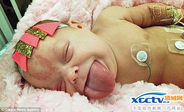 贝克威思-威德曼综合症