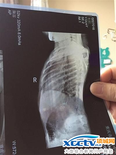 玲玲的X光片。