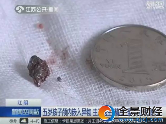 5岁娃脑子进异物 医生抱着头“摇”了3小时
