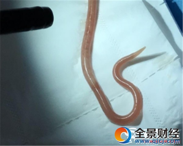 吃麻辣烫体内长巨虫 20厘米长蛔虫从肠道取出 吃麻辣烫体内长巨虫 20厘米长蛔虫从肠道取出