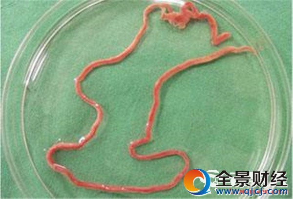 吃麻辣烫体内长巨虫 20厘米长蛔虫从肠道取出 吃麻辣烫体内长巨虫 20厘米长蛔虫从肠道取出