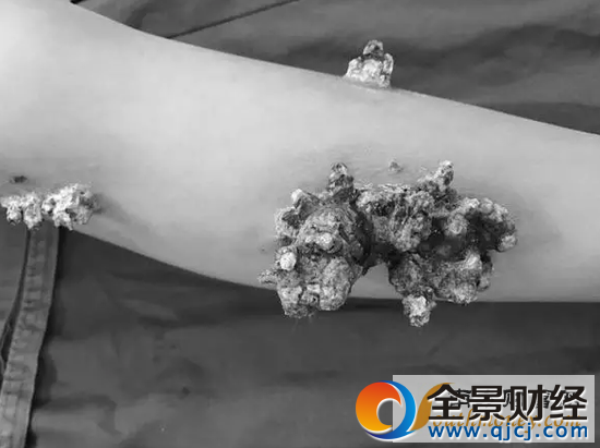 男孩身上长珊瑚