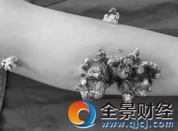 湖南5岁男孩身上长珊瑚 肿块从手指向腿脚蔓延