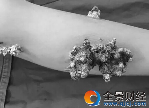 湖北5岁男孩身上长珊瑚 患处又痒又痛治疗后未见成效