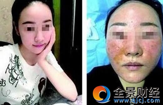 花3万美容变毁容 美女骨胶原美容后皮肤爆皮流黄水