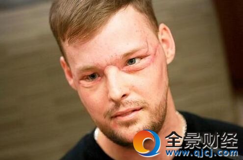 美国男子吞枪毁脸 经过医生56小时的手术成功移植新脸