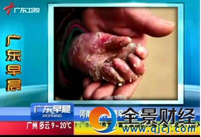 8岁女童患皮肤怪病一碰即烂 网友:层层掉皮看着都心疼