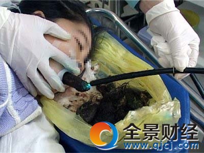 6岁女童患异食癖爱吃头发 腹部肿块内含巨大毛发团