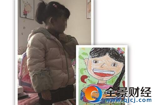 女童皮肤一碰即烂被称