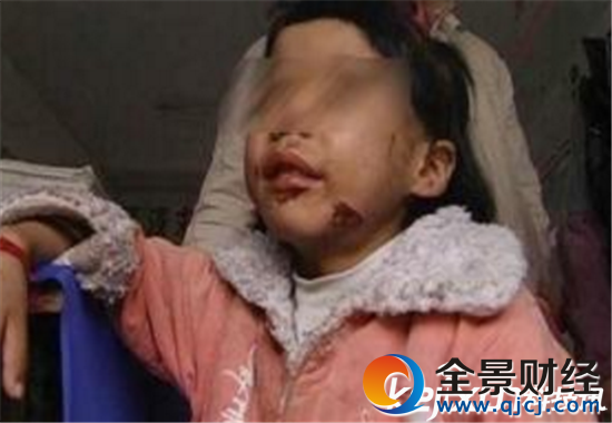 小学生遭撕裂耳朵 未完成作业被老师打太震惊