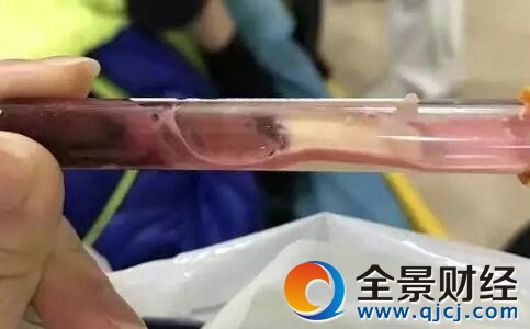 男孩抽出的血马上凝固:沉淀后悬浮白色脂类物质占一半