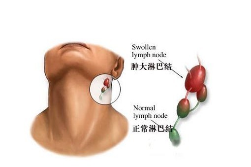 神出鬼没的淋巴瘤