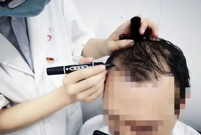 坚持健身半年多20多岁小伙竟头秃 脂溢性脱发让人无奈