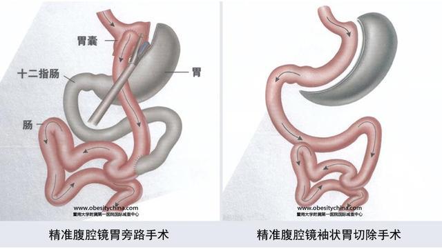 切胃减肥手术有什么副作用？饮食上需要注意什么？
