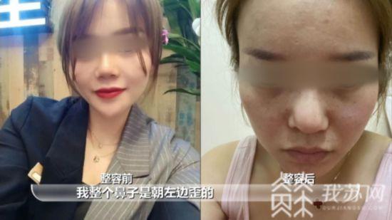 女子鼻子整形后歪了 院方拒绝提供病历卫监部门介入调查