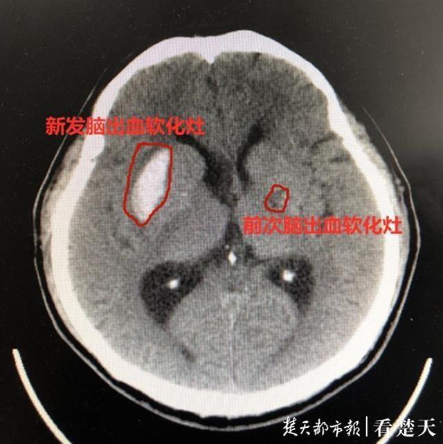 男子半年两度脑出血 “元凶”竟是原发性醛固酮增多症