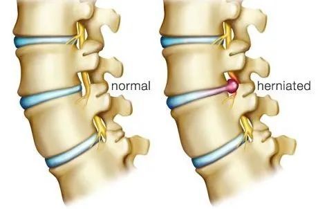 腰椎间盘突出症时轻时重 该如何治疗呢？