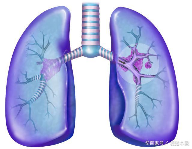 肺癌如出现症状 身体的表现一般有哪些？