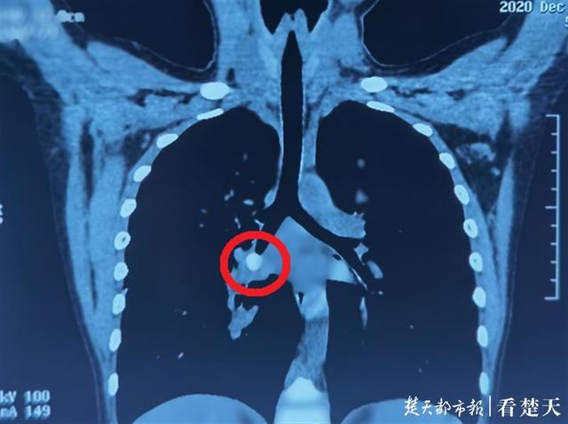 辅导作业起冲突 虎妈一巴掌将孩子乳牙打进气管