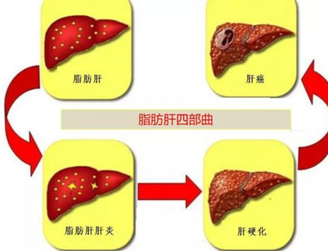 脂肪肝不控制会发展为肝癌 如何治疗脂肪肝？