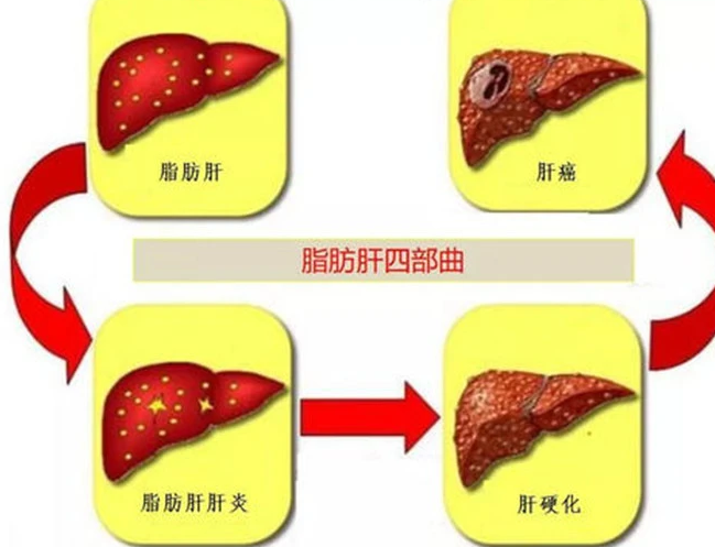 脂肪肝不控制会发展为肝癌！肥胖、长期酗酒等