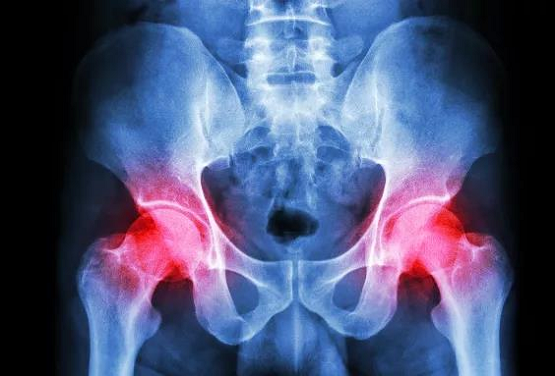中医药辨证治疗股骨头坏死，提升保髋成功率优势明显