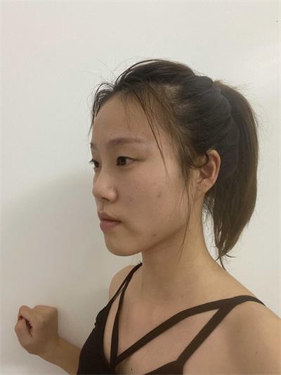 徐州医科汇美美容医院綦孝堃院长：韩式无痕双眼皮术前注意事项有哪些