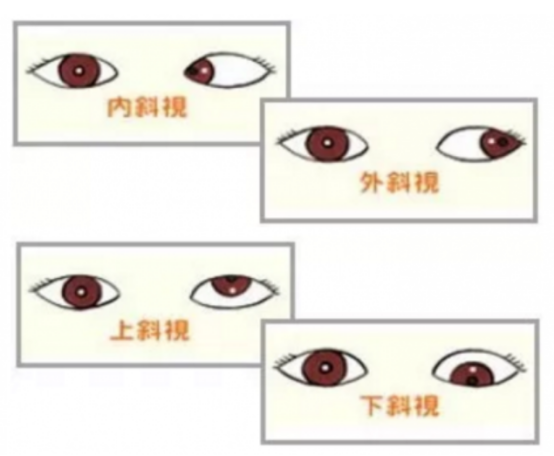泰康仙林鼓樓醫(yī)院提醒家長重視兒童斜視問題