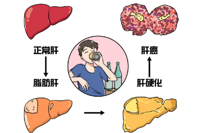 脂肪肝怎么应对医生给我推荐护肝小黄盒易善复”